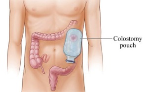 colostomy diagram