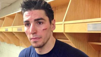 Video: Alex Burrows takes a skate to the face